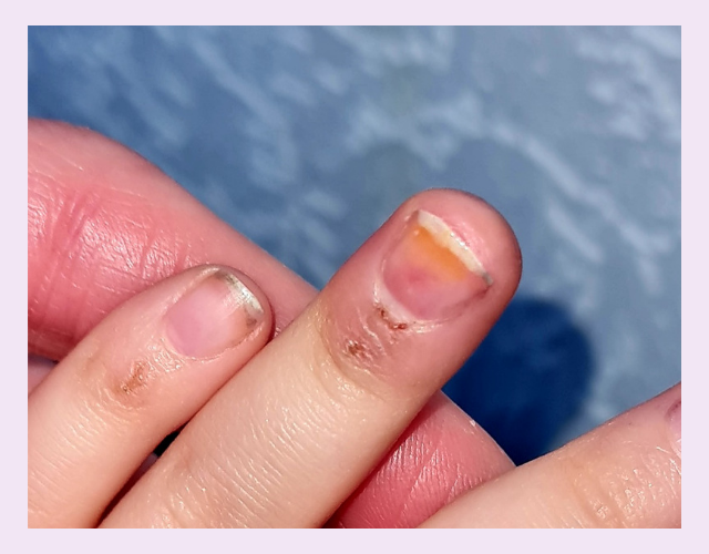 Bruised toddler finger
